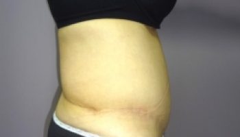 10_Abdominoplasty_After1