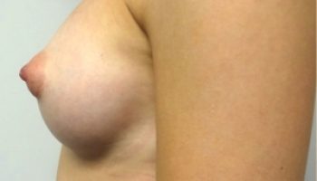 12_breast-augmentation-after-Example-23