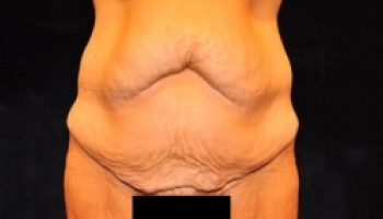 17_abdominoplasty-before1