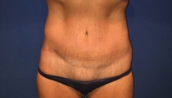 18_abdominoplasty-after1