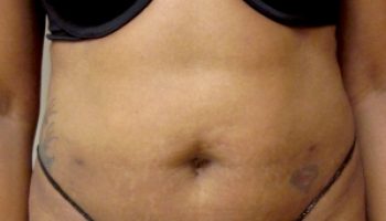 22_Liposuction-After1