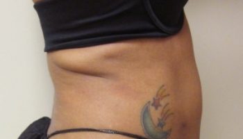 24_Liposuction-After1