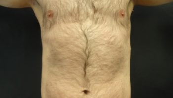 30_Liposuction-after1