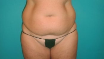 33_ABDOMINIOPLASTY_before1