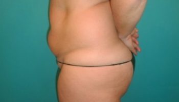 36_abdominoplasty-before1