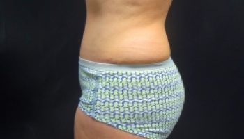 37_Abdominoplasty-after1