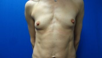 5_Breast-Augmentation-Before1