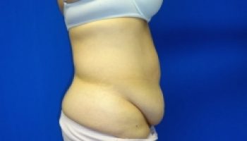 9_Abdominoplasty-Before1