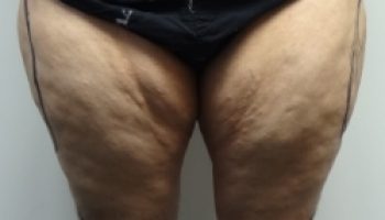 AP-Thighs-preop3