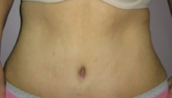 Abdominoplasty8-a1