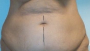 Abdominoplasty8-b1