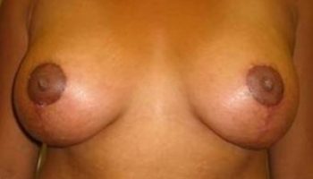 Breast-Implants-after-1439861