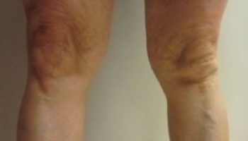 Knees-lipo-PreOp4