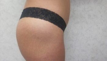 Rt.-lateral-postop-buttocks2