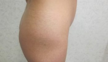 Rt.-lateral-preop-buttocks2