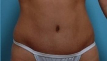 abdominoplasty4-postop-ap-tummy-tuck-copy1