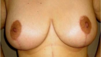 breast-reduction-post2