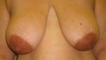 breast-reduction-pre2