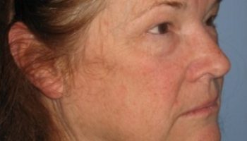 facelift-oblique-preop4