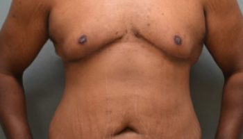 gynecomastia-p-2-after2