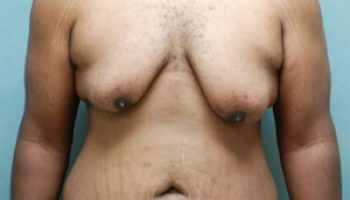 gynecomastia-p-2-before2