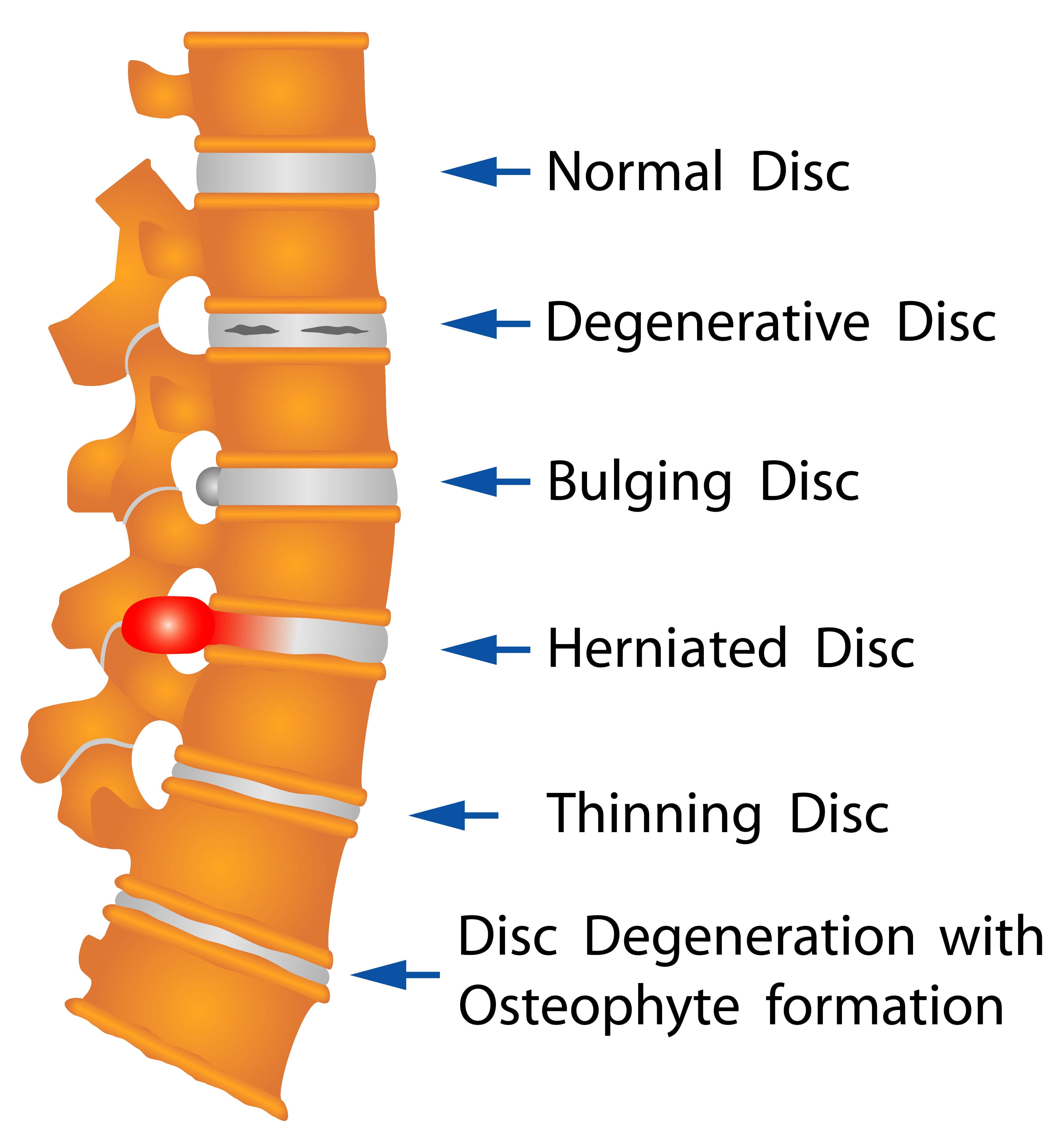 degenerative disc disease