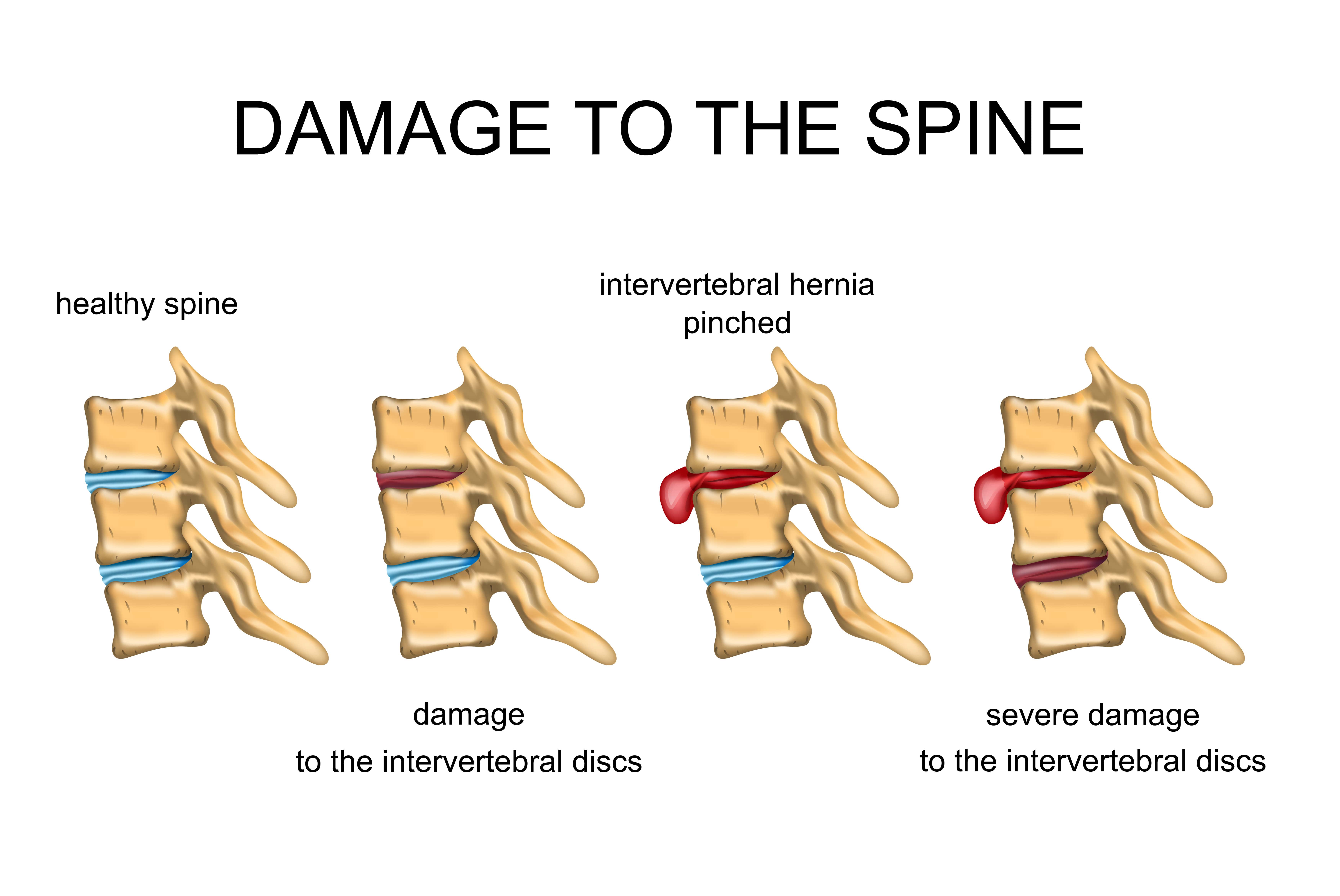 Herniated Disc