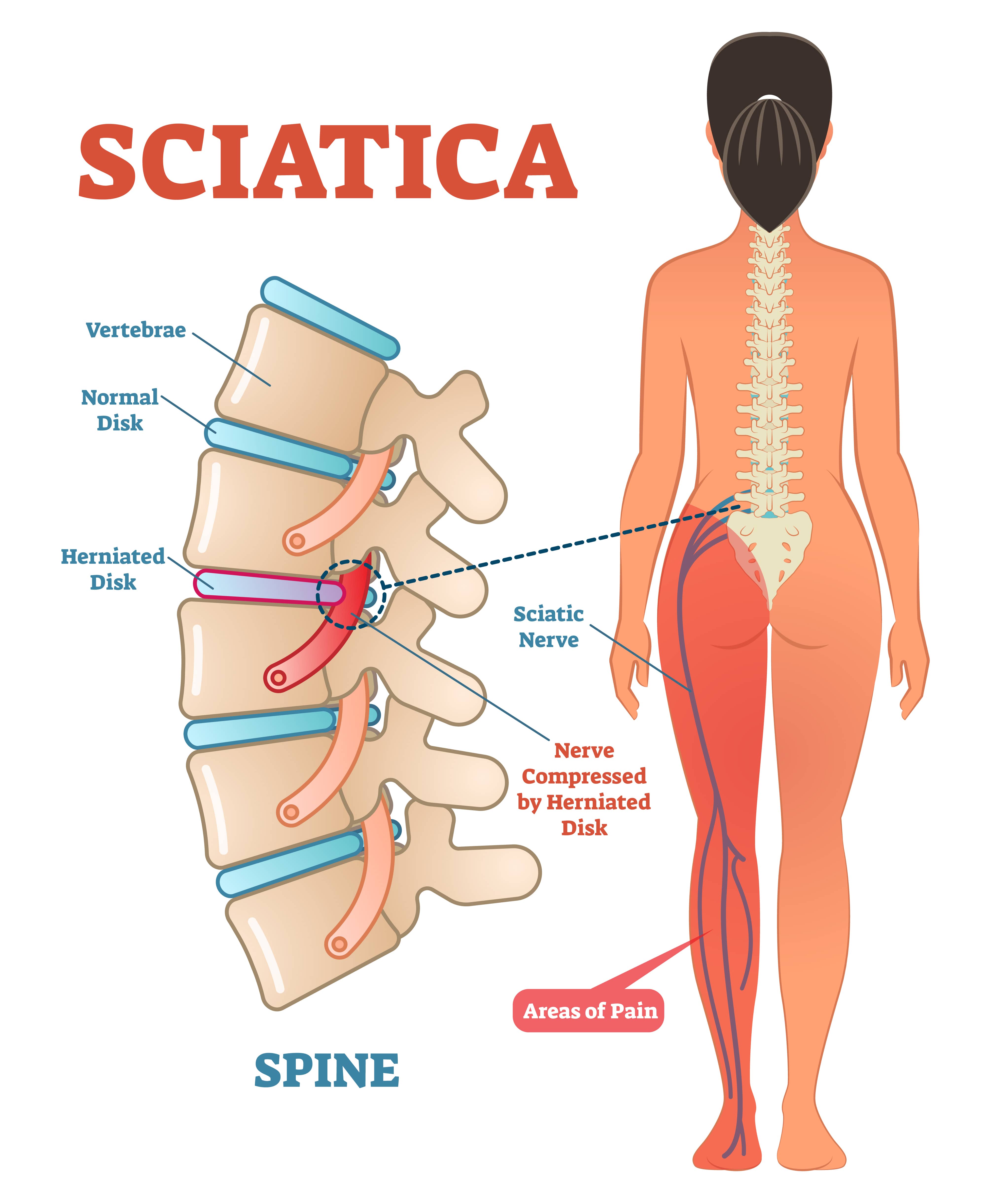 sciatica pain symptoms