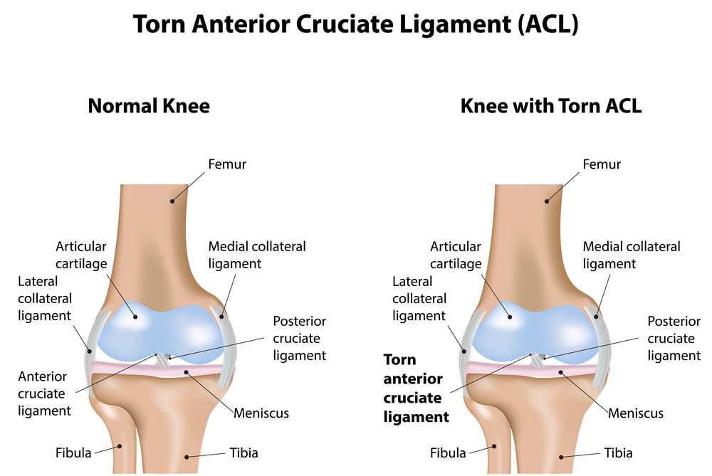 ACL tear - sports injury