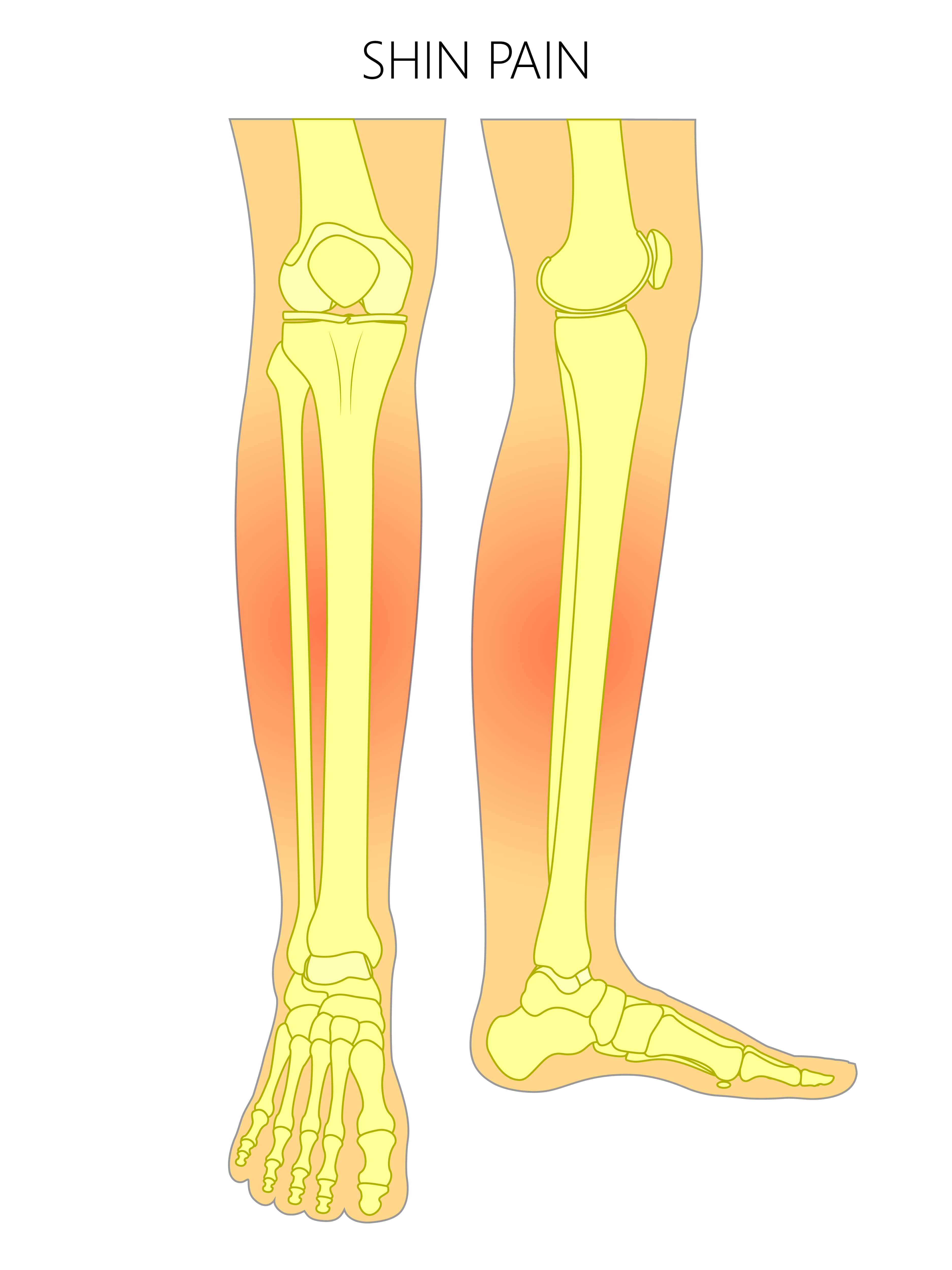 shin splints - sports injury